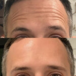 botox man before after forehead