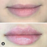 Dermal filler before and after lips